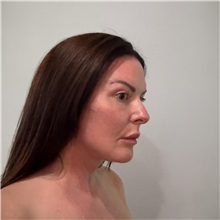 Facelift After Photo by Cem Berkay SINACI, MD; Istanbul, M - Case 50987