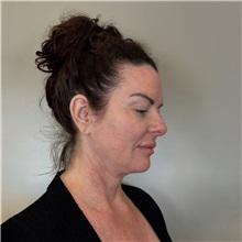 Facelift Before Photo by Cem Berkay SINACI, MD; Istanbul, M - Case 50987