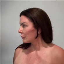 Facelift After Photo by Cem Berkay SINACI, MD; Istanbul, M - Case 50987
