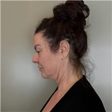 Facelift Before Photo by Cem Berkay SINACI, MD; Istanbul, M - Case 50987