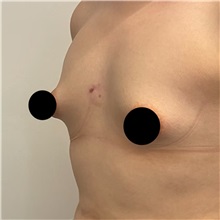 Breast Augmentation Before Photo by Cem Berkay SINACI, MD; Istanbul, M - Case 50991
