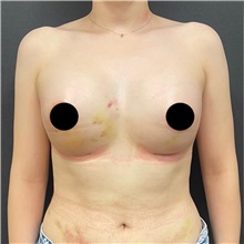 Breast Augmentation After Photo by Cem Berkay SINACI, MD; Istanbul, M - Case 50991