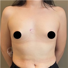 Breast Augmentation Before Photo by Cem Berkay SINACI, MD; Istanbul, M - Case 50991