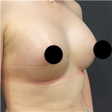 Breast Augmentation After Photo by Cem Berkay SINACI, MD; Istanbul, M - Case 50991