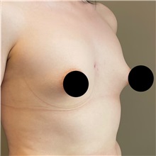 Breast Augmentation Before Photo by Cem Berkay SINACI, MD; Istanbul, M - Case 50991