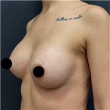 Breast Augmentation After Photo by Cem Berkay SINACI, MD; Istanbul, M - Case 50989