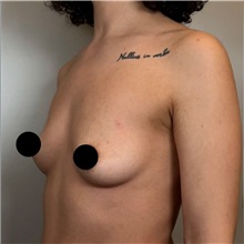 Breast Augmentation Before Photo by Cem Berkay SINACI, MD; Istanbul, M - Case 50989