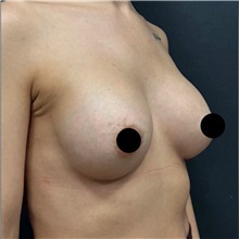 Breast Augmentation After Photo by Cem Berkay SINACI, MD; Istanbul, M - Case 50989