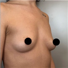 Breast Augmentation Before Photo by Cem Berkay SINACI, MD; Istanbul, M - Case 50989
