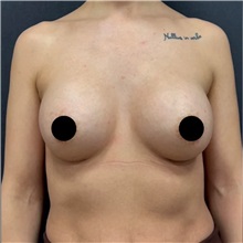 Breast Augmentation After Photo by Cem Berkay SINACI, MD; Istanbul, M - Case 50989