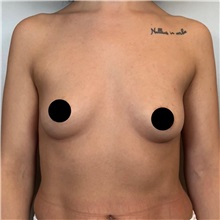 Breast Augmentation Before Photo by Cem Berkay SINACI, MD; Istanbul, M - Case 50989