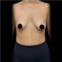 Breast Augmentation Before Photo by Cem Berkay SINACI, MD; Istanbul, M - Case 50992