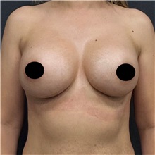 Breast Augmentation After Photo by Cem Berkay SINACI, MD; Istanbul, M - Case 50990