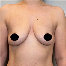 Breast Augmentation Before Photo by Cem Berkay SINACI, MD; Istanbul, M - Case 50990