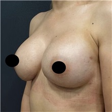 Breast Augmentation After Photo by Cem Berkay SINACI, MD; Istanbul, M - Case 50990