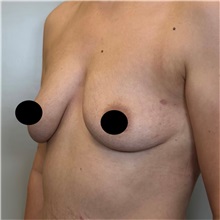 Breast Augmentation Before Photo by Cem Berkay SINACI, MD; Istanbul, M - Case 50990