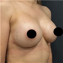 Breast Augmentation After Photo by Cem Berkay SINACI, MD; Istanbul, M - Case 50990