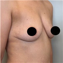 Breast Augmentation Before Photo by Cem Berkay SINACI, MD; Istanbul, M - Case 50990