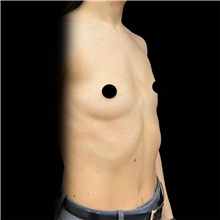 Breast Augmentation Before Photo by Cem Berkay SINACI, MD; Istanbul, M - Case 50993