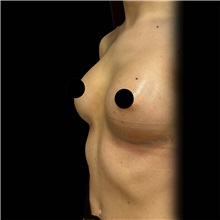Breast Augmentation After Photo by Cem Berkay SINACI, MD; Istanbul, M - Case 50993