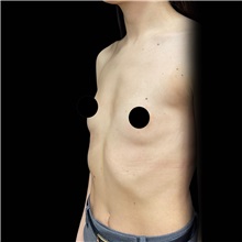 Breast Augmentation Before Photo by Cem Berkay SINACI, MD; Istanbul, M - Case 50993