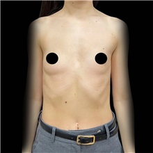 Breast Augmentation Before Photo by Cem Berkay SINACI, MD; Istanbul, M - Case 50993