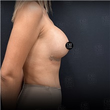 Breast Augmentation After Photo by Cem Berkay SINACI, MD; Istanbul, M - Case 51006