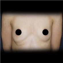 Breast Augmentation Before Photo by Cem Berkay SINACI, MD; Istanbul, M - Case 51007