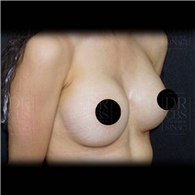 Breast Augmentation After Photo by Cem Berkay SINACI, MD; Istanbul, M - Case 51007