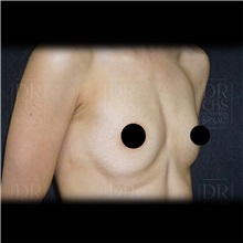 Breast Augmentation Before Photo by Cem Berkay SINACI, MD; Istanbul, M - Case 51007