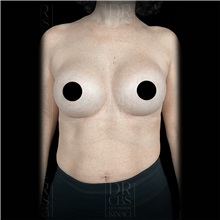 Breast Augmentation After Photo by Cem Berkay SINACI, MD; Istanbul, M - Case 51016