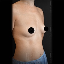 Breast Augmentation Before Photo by Cem Berkay SINACI, MD; Istanbul, M - Case 51016