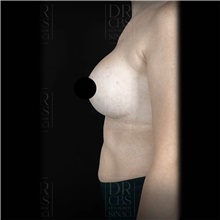Breast Augmentation After Photo by Cem Berkay SINACI, MD; Istanbul, M - Case 51016