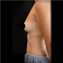 Breast Augmentation Before Photo by Cem Berkay SINACI, MD; Istanbul, M - Case 51016