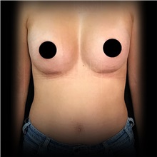 Breast Augmentation After Photo by Cem Berkay SINACI, MD; Istanbul, M - Case 51005