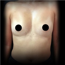 Breast Augmentation Before Photo by Cem Berkay SINACI, MD; Istanbul, M - Case 51005