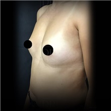 Breast Augmentation Before Photo by Cem Berkay SINACI, MD; Istanbul, M - Case 51005