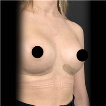 Breast Augmentation After Photo by Cem Berkay SINACI, MD; Istanbul, M - Case 51008