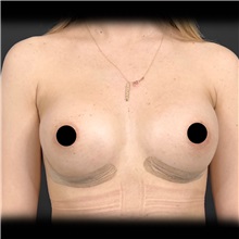 Breast Augmentation After Photo by Cem Berkay SINACI, MD; Istanbul, M - Case 51008