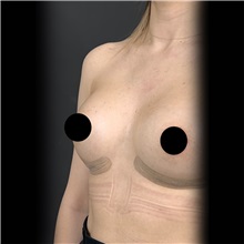 Breast Augmentation After Photo by Cem Berkay SINACI, MD; Istanbul, M - Case 51008