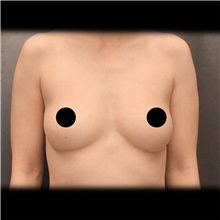 Breast Augmentation Before Photo by Cem Berkay SINACI, MD; Istanbul, M - Case 51013