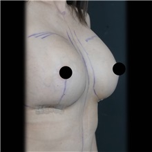 Breast Augmentation After Photo by Cem Berkay SINACI, MD; Istanbul, M - Case 51013