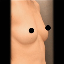 Breast Augmentation Before Photo by Cem Berkay SINACI, MD; Istanbul, M - Case 51013