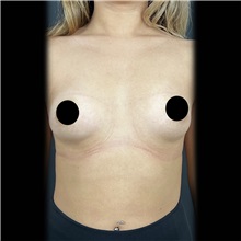 Breast Augmentation Before Photo by Cem Berkay SINACI, MD; Istanbul, M - Case 51011