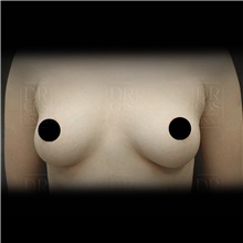 Breast Augmentation Before Photo by Cem Berkay SINACI, MD; Istanbul, M - Case 51009