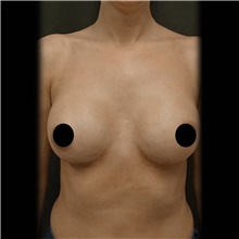 Breast Augmentation After Photo by Cem Berkay SINACI, MD; Istanbul, M - Case 51012
