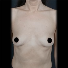 Breast Augmentation Before Photo by Cem Berkay SINACI, MD; Istanbul, M - Case 51012