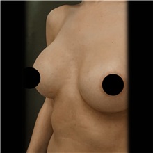 Breast Augmentation After Photo by Cem Berkay SINACI, MD; Istanbul, M - Case 51012