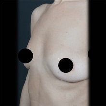 Breast Augmentation Before Photo by Cem Berkay SINACI, MD; Istanbul, M - Case 51012