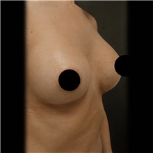 Breast Augmentation After Photo by Cem Berkay SINACI, MD; Istanbul, M - Case 51012